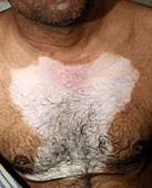 Vitiligo skin patch
