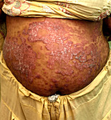 Psoriasis on the abdomen