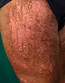 Psoriasis on the thigh