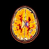 Multiple sclerosis, axial brain MRI scan