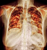 Pulmonary fibrosis, coloured x-ray