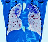 Pulmonary sarcoidosis, CT scan