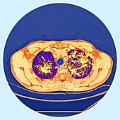 Pulmonary sarcoidosis, CT scan