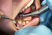 Dental crown preparation