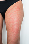 Allergic dermatitis