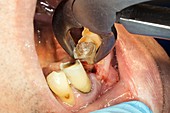 Decayed lower incisor extraction