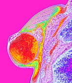 Breast cancer, MRI scan