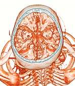 Intracranial blood vessels, 3D CT angiogram