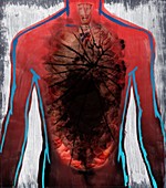 Illustration of cancer affected human organ