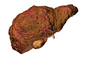 Liver cirrhosis, illustration