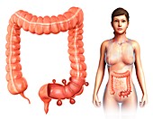 Woman with diverticulosis, illustration