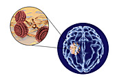 Aspergilloma of the brain, illustration