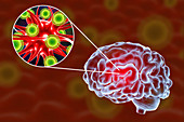Viral encephalitis, illustration