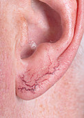 Telangiectasia of the ear lobe
