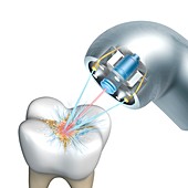 Dental hygiene laser, illustration