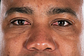 Pterygium eye disorder
