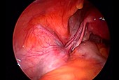 Fallopian tube and round ligament, endoscope view