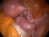 Swollen fallopian tube