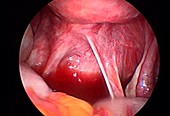 Uterosacral ligament, endoscope view