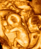 Triplet foetuses, 3D ultrasound scan