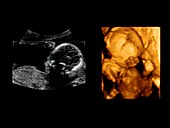 Foetus at 20 weeks, ultrasound scans