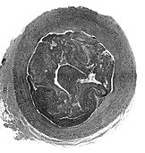 Thrombus, light micrograph