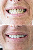 Dental facets