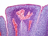Genital wart, light micrograph