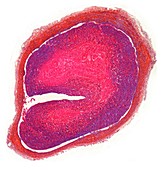 Deep vein thrombosis, light micrograph