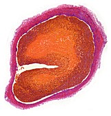 Deep vein thrombosis, light micrograph