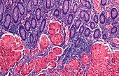 Colon cancer, light micrograph