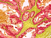 Ovarian tumour, light micrograph