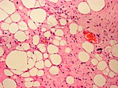 Connective tissue cancer, light micrograph