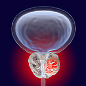 Prostate cancer, illustration