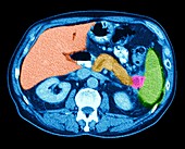 Pancreatic cancer, CT scan