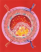 Atherosclerosis in an artery, illustration