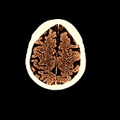 Brain, CT scan