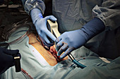 Open heart surgery, bone saw