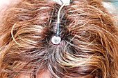 Electroencephalography electrode attached to scalp