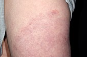 Rash in Lyme's disease