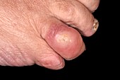 Cellulitis of a toe