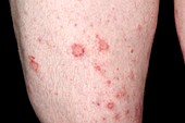 Eczema