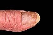 Dystrophic nail in chronic eczema