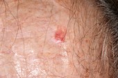 Atypical fibroxanthoma