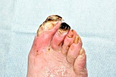 Gangrenous toes in diabetes