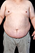 Obese man with fatty liver