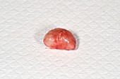 Excised trichilemmal cyst