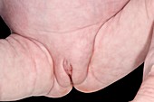 Inguinal hernia in premature baby