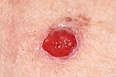 Ulcerated malignant melanoma