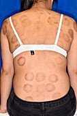 Cupping marks from cupping therapy